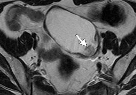 endometriosis radiology mri